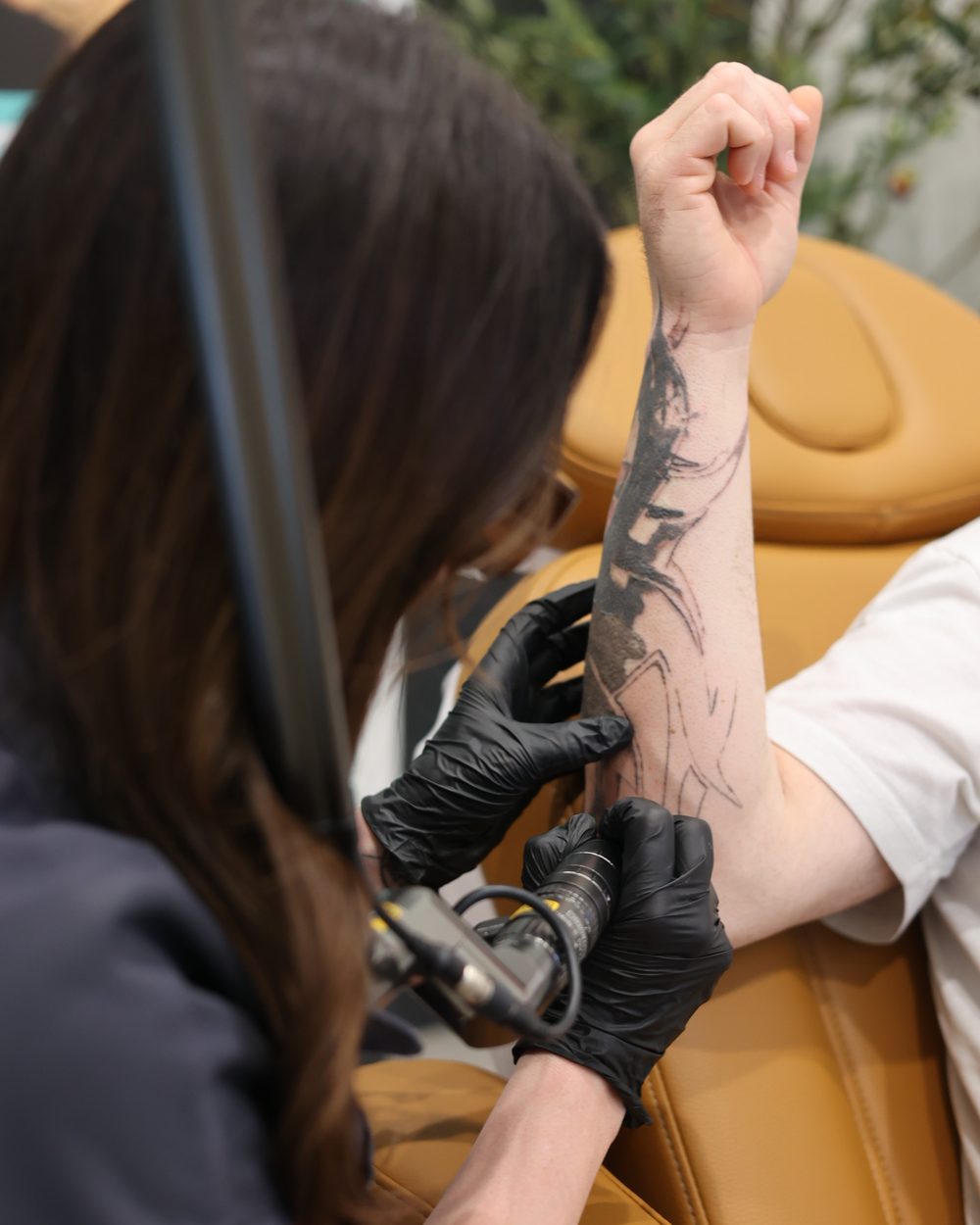 A Gudgel Aesthetics provider treating a forearm tattoo with the laser